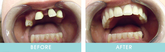 Before & After Dentures Transformation