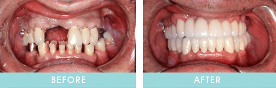 Before & After Dental Implants Transformation